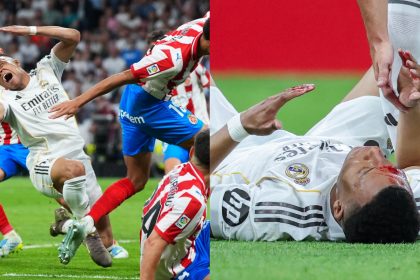 That's Gotta Hurt! Real Madrid's Kylian Mbappé Left With Bloody Gash